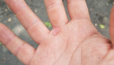 blister_hand