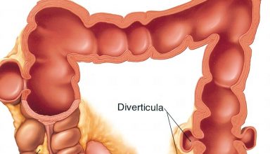 diverticulitis (1)