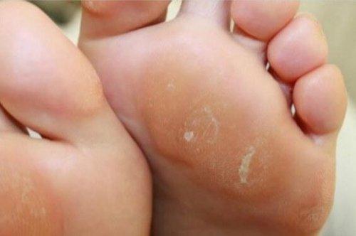 person-feet-calluses-e1549293721653