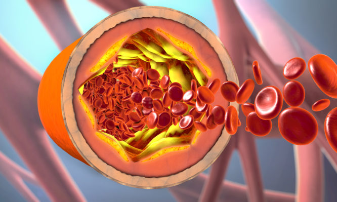 3d illustration of a precipitated and narrowing blood vessels or arteriosclerosis