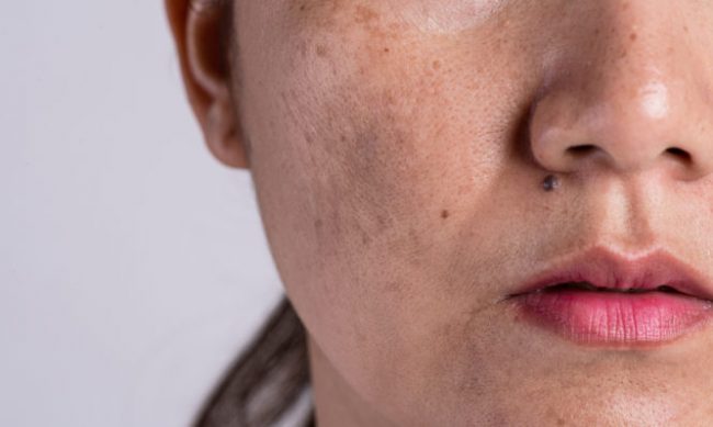 Woman with problematic skin and acne scars. Problem skincare and health concept. Wrinkles melasma Dark spots freckles dry skin and pigmentation on face asian woman.