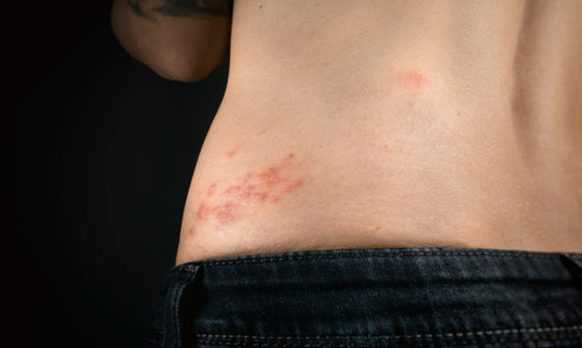 The varicella-zoster virus has formed a red rash with fluid-filled blisters on the lower back (shingles belt)
