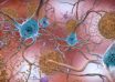 This illustration made available by the National Institute on Aging/National Institutes of Health depicts cells in an Alzheimer’s affected brain, with abnormal levels of the beta-amyloid protein clumping together to form plaques, brown, that collect between neurons and disrupt cell function. Abnormal collections of the tau protein accumulate and form tangles, blue, within neurons, harming synaptic communication between nerve cells. An experimental Alzheimer’s drug modestly slowed the brain disease’s inevitable worsening, researchers reported Tuesday, Nov. 29, 2022 - and the next question is how much difference that might make in people’s lives. Japanese drugmaker Eisai and its U.S. partner Biogen had announced earlier this fall that the drug lecanemab appeared to work, a badly needed bright spot after repeated disappointments in the quest for better Alzheimer’s treatments. (National Institute on Aging, NIH via AP)
