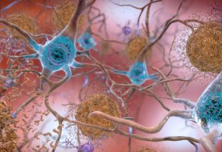 This illustration made available by the National Institute on Aging/National Institutes of Health depicts cells in an Alzheimer’s affected brain, with abnormal levels of the beta-amyloid protein clumping together to form plaques, brown, that collect between neurons and disrupt cell function. Abnormal collections of the tau protein accumulate and form tangles, blue, within neurons, harming synaptic communication between nerve cells. An experimental Alzheimer’s drug modestly slowed the brain disease’s inevitable worsening, researchers reported Tuesday, Nov. 29, 2022 - and the next question is how much difference that might make in people’s lives. Japanese drugmaker Eisai and its U.S. partner Biogen had announced earlier this fall that the drug lecanemab appeared to work, a badly needed bright spot after repeated disappointments in the quest for better Alzheimer’s treatments. (National Institute on Aging, NIH via AP)