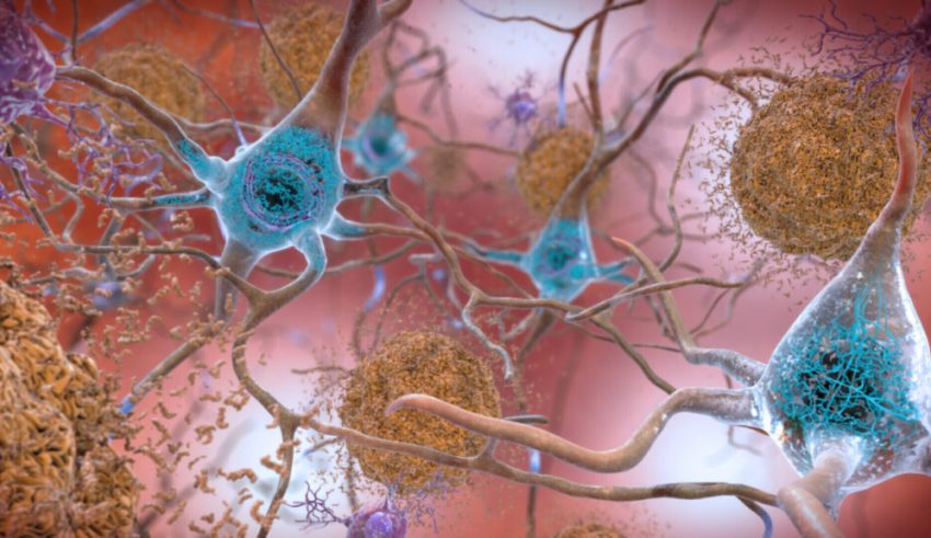 This illustration made available by the National Institute on Aging/National Institutes of Health depicts cells in an Alzheimer’s affected brain, with abnormal levels of the beta-amyloid protein clumping together to form plaques, brown, that collect between neurons and disrupt cell function. Abnormal collections of the tau protein accumulate and form tangles, blue, within neurons, harming synaptic communication between nerve cells. An experimental Alzheimer’s drug modestly slowed the brain disease’s inevitable worsening, researchers reported Tuesday, Nov. 29, 2022 - and the next question is how much difference that might make in people’s lives. Japanese drugmaker Eisai and its U.S. partner Biogen had announced earlier this fall that the drug lecanemab appeared to work, a badly needed bright spot after repeated disappointments in the quest for better Alzheimer’s treatments. (National Institute on Aging, NIH via AP)